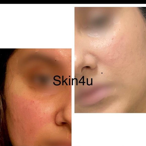 Cleans Skin Pores, Radiance & Glow, Spot Removal, Pigmentation Removal, Anti-age - Picture 3 of 3